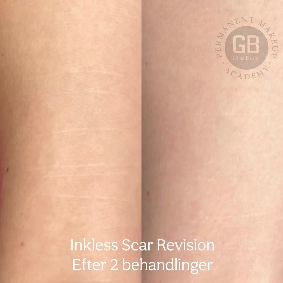 Før og efter Inkless Scar Revision