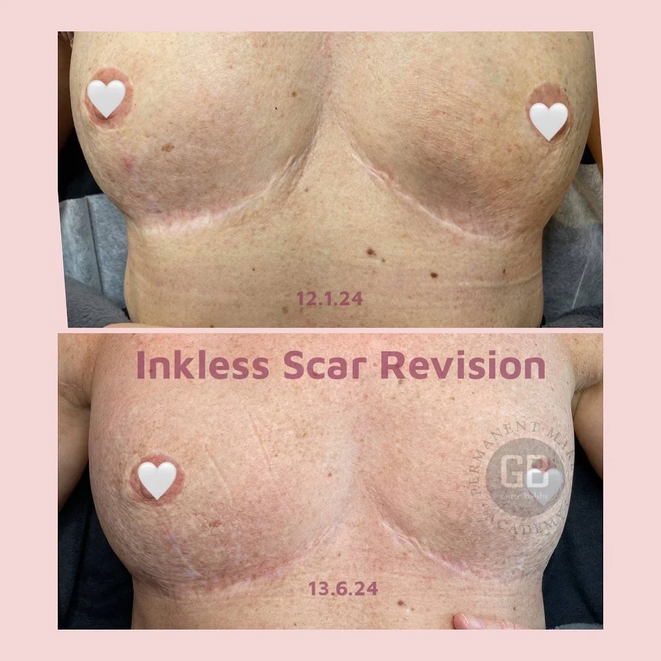 Før og efter Inkless Scar Revision