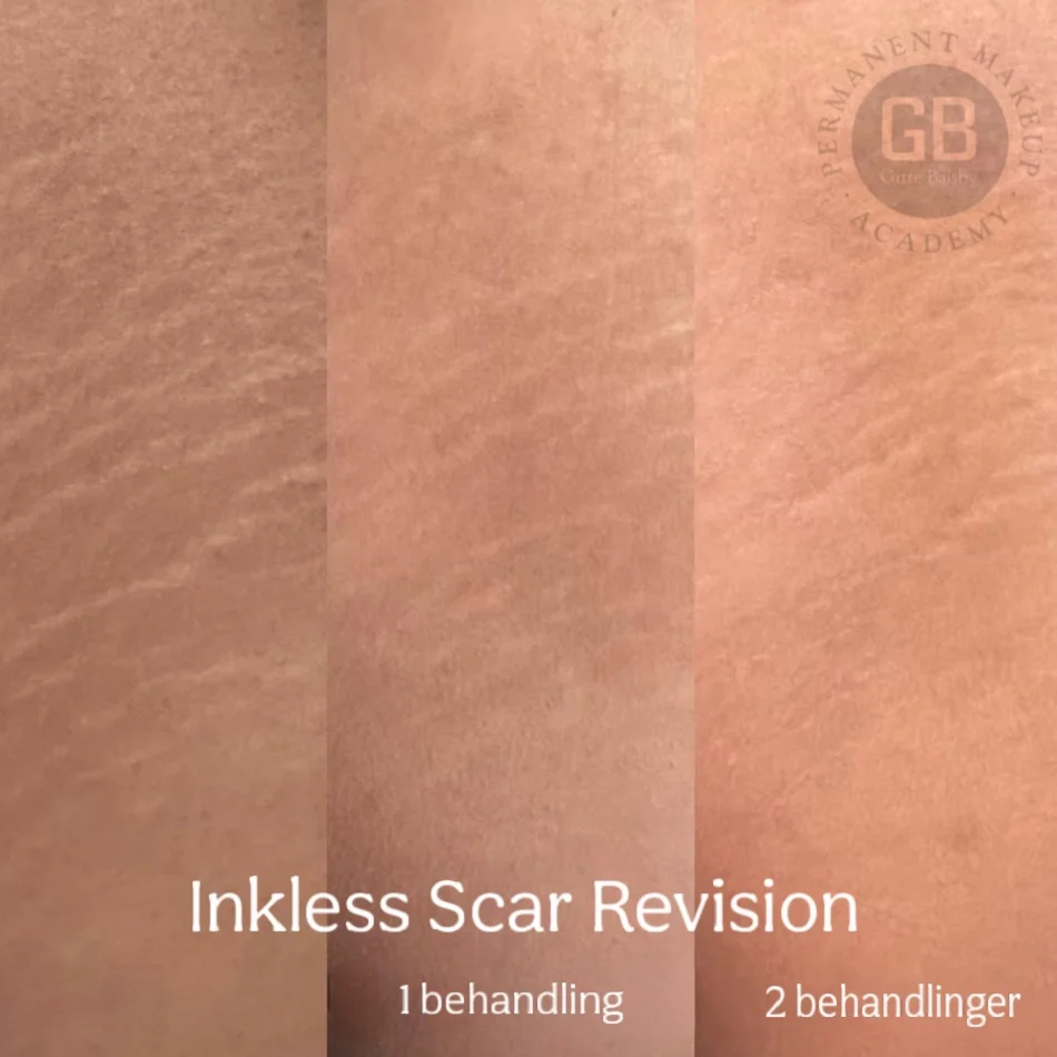 Før og efter Inkless Scar Revision